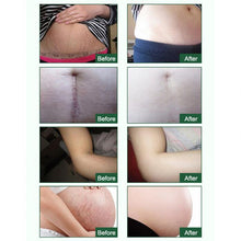 Load image into Gallery viewer, Pregnancy Scars &amp; Stretch Marks Repair Essential Oil (30mL)