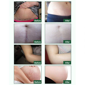 Pregnancy Scars & Stretch Marks Repair Essential Oil (30mL)