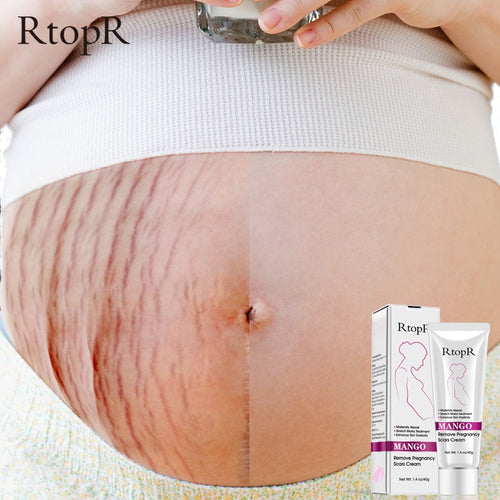 Pregnancy Scars & Stretch Marks  Repairing Cream