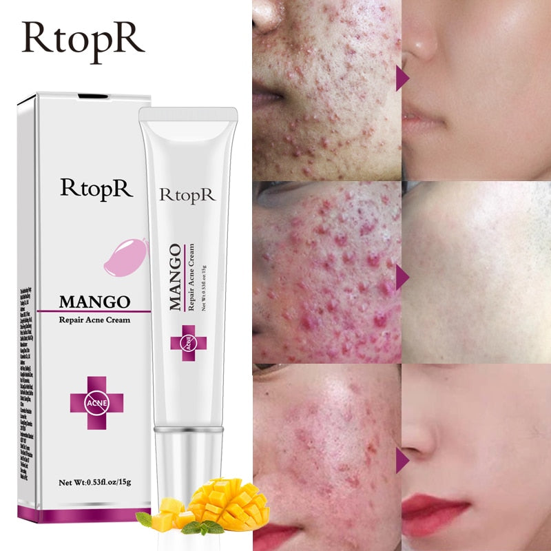 Mango Acne Repair Cream