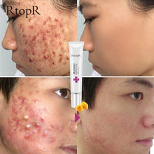 Load image into Gallery viewer, Mango Acne Repair Cream