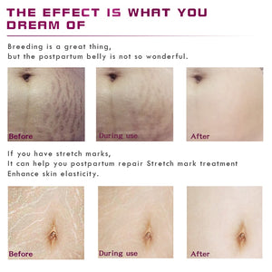 Pregnancy Scars & Stretch Marks  Repairing Cream