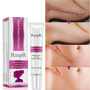 Scar  Marks Remover Cream